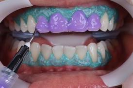 Whitening-teeth-procedure